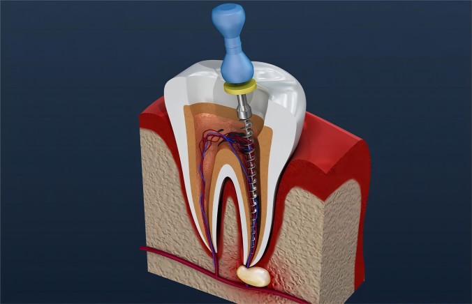 Do you know what a root canal is?