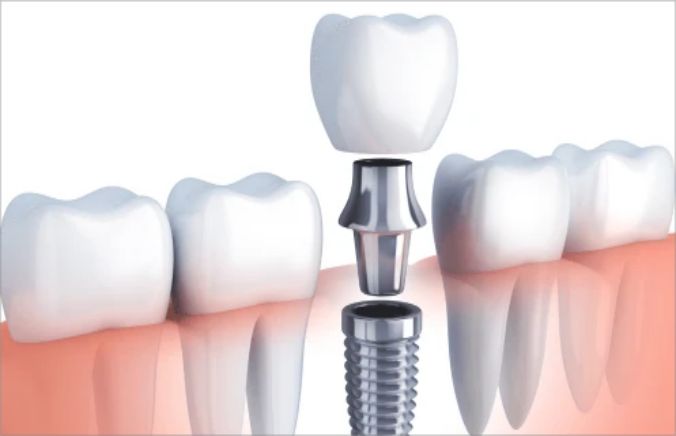 The evolution of dental implant technology: from tradition to innovation