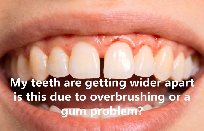 Widening Gaps Between Teeth: Over-cleaning or Gum Problems?