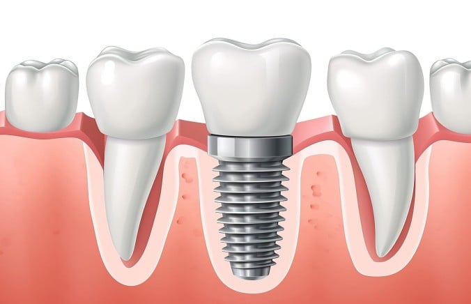Are Dental Implants Covered by Health Insurance?