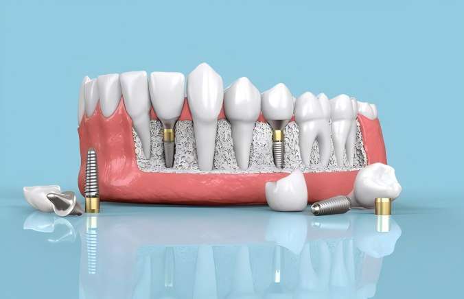 Can children get dental implants? Answers to Parents' Concerns