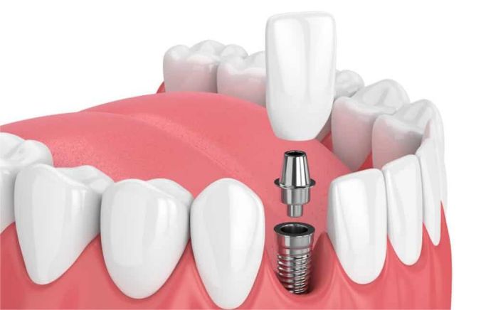 Dental implant treatment options and related planning