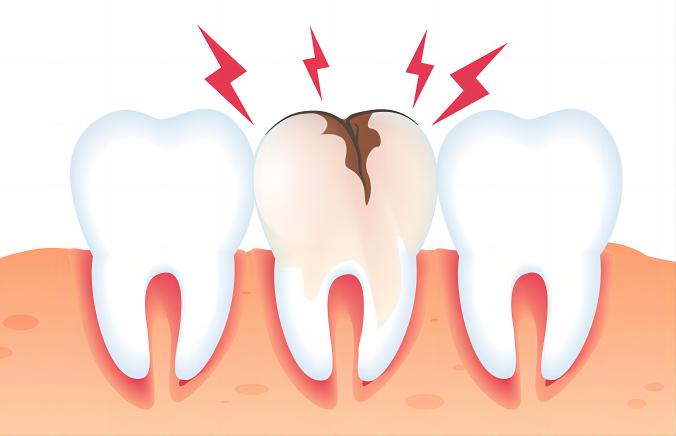 What are cavities and tooth decay?