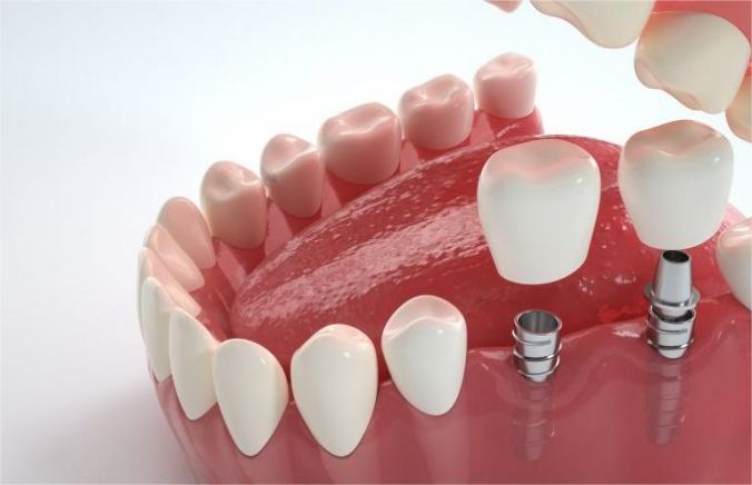 Combination of dental implants and orthodontics