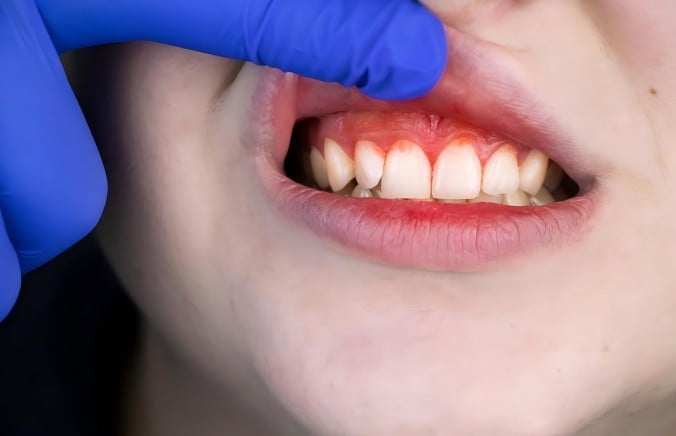 Bleeding gums? Habits you need to change right away!