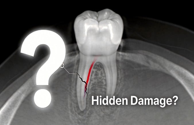 Can Dental Crowns Be Harmful? A Fact-Based Look at the Health Risks of Dental Crowns