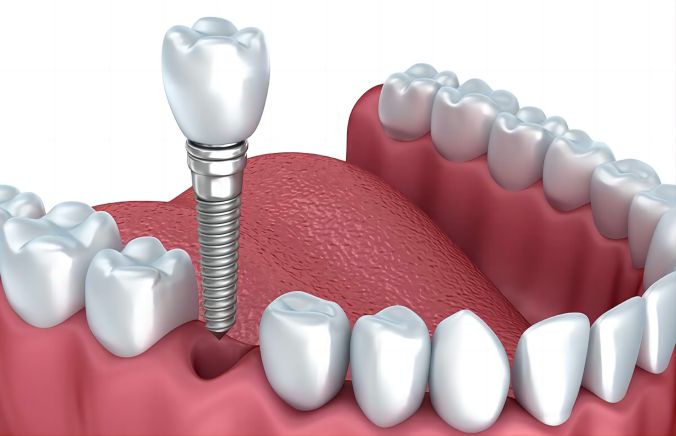 Does dental insurance cover dental implants?