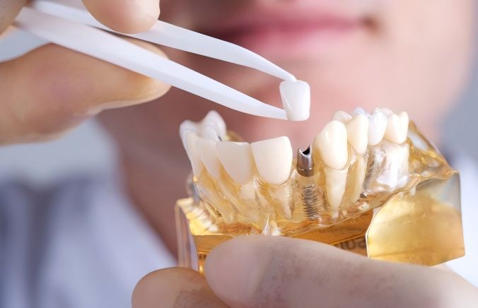 Dental implant surgery risks and complications, learn in advance to be prepared
