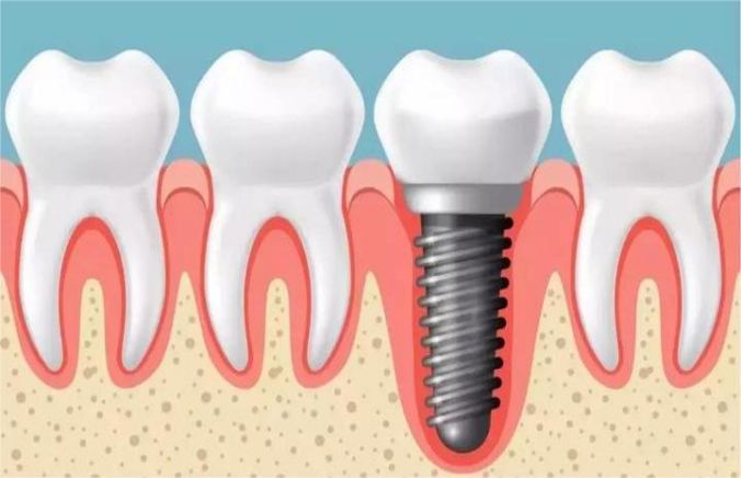 Compatibility and stability of dental implants with surrounding tissues