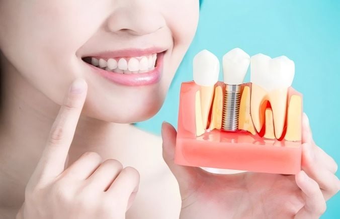 Dental Implants: Advantages, Disadvantages, Suitable Crowds and Precautions