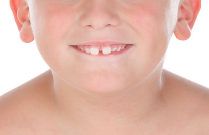 What should I do if the gap between my teeth is too large?