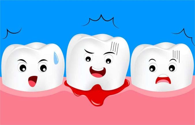 Learn about gum disease, its stages and how to prevent it.